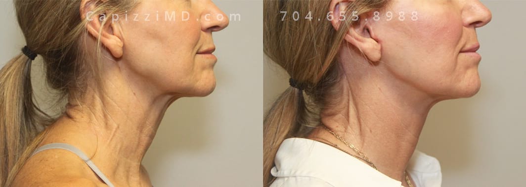 Mini neck lift corrected all concerns. 8 weeks post-op.