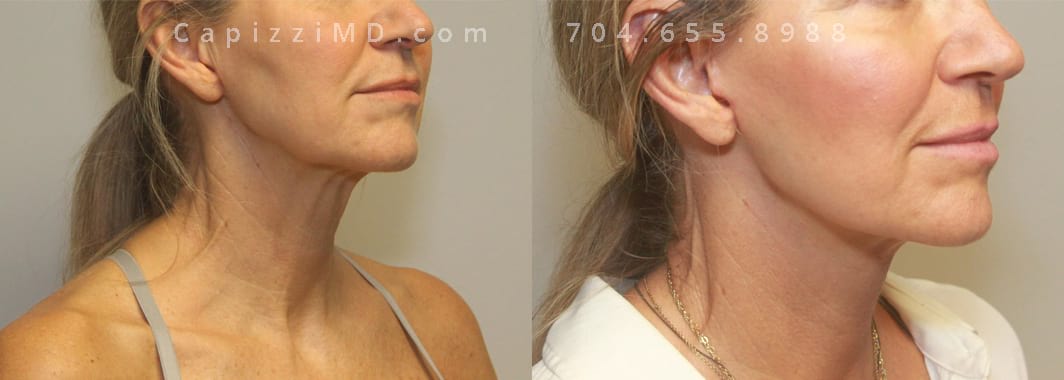 Mini neck lift corrected all concerns. 8 weeks post-op.