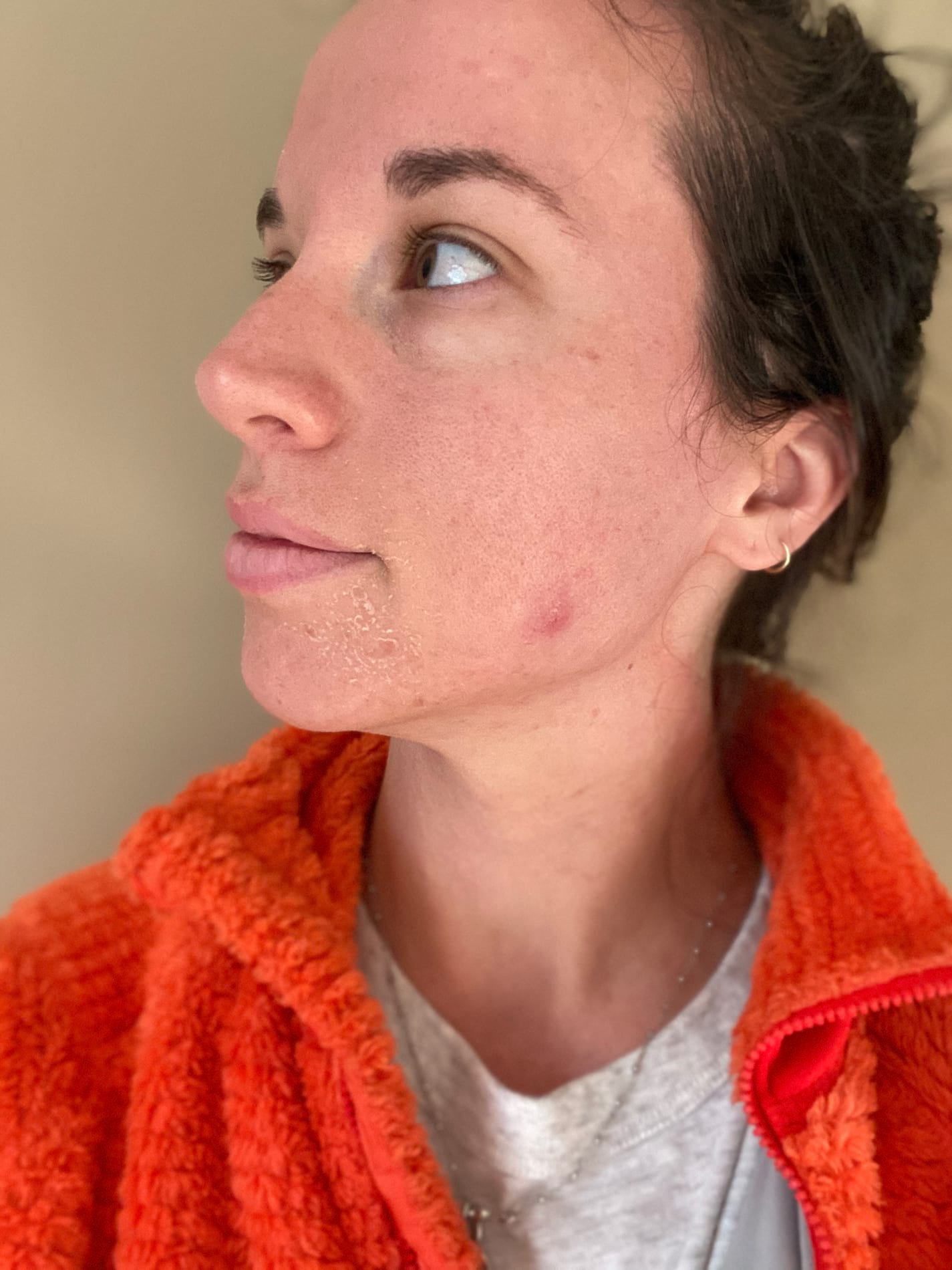 2 Days After Medium-level Chemical Peel showing some mild peeling on the left chin area.