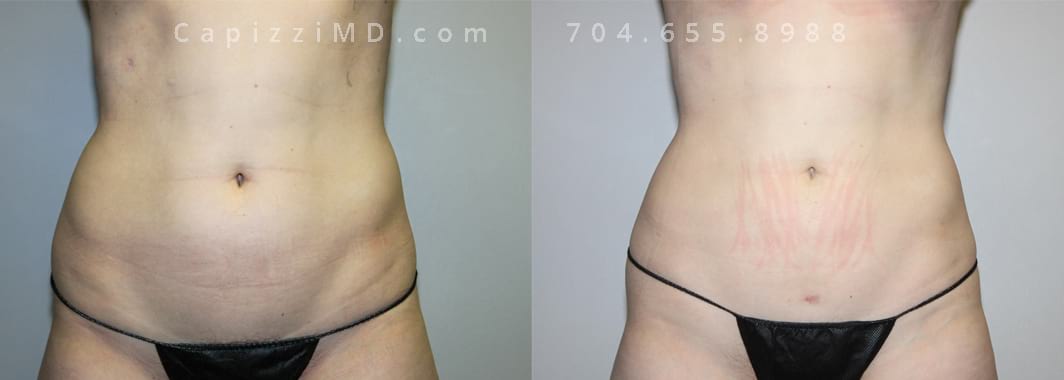 Sientra Shaped Classic Base Moderate Projection 400cc. Profound to lateral, posterior thighs and buttocks. Fat grafting to breasts: donor sites abdomen and posterior hips. 5’ 8” 149lbs. Lower front view.