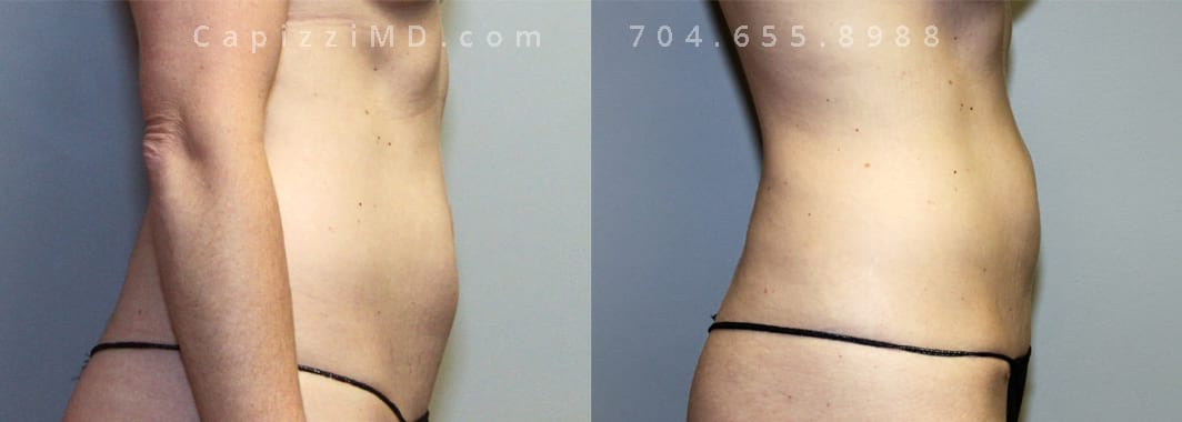 5’ 9” 140lbs Mini Tummy Tuck. Liposuction 360. Right view.