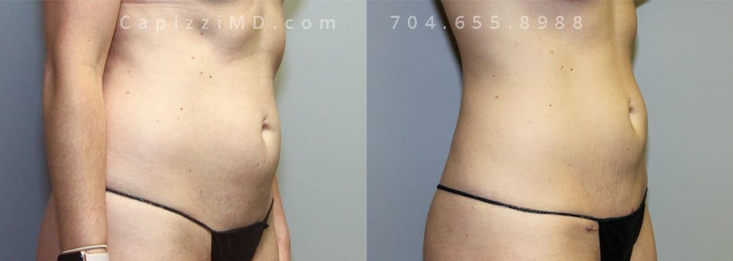5’ 9” 140lbs Mini Tummy Tuck. Liposuction 360. Right oblique view.