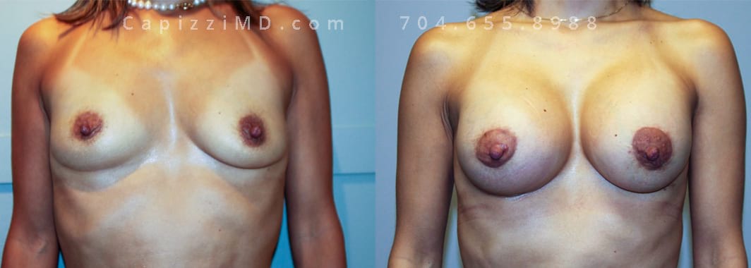 5’ 107lbs. Breast augmentation with modified lift. Sientra Textured Shaped Round Base HP 370cc. 6 months post. Front view.