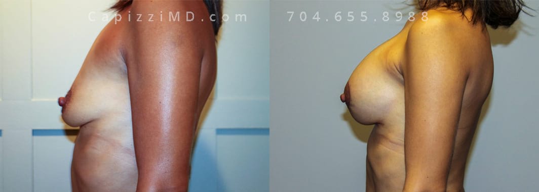 5’ 107lbs. Breast augmentation with modified lift. Sientra Textured Shaped Round Base HP 370cc. 6 months post. Left view.