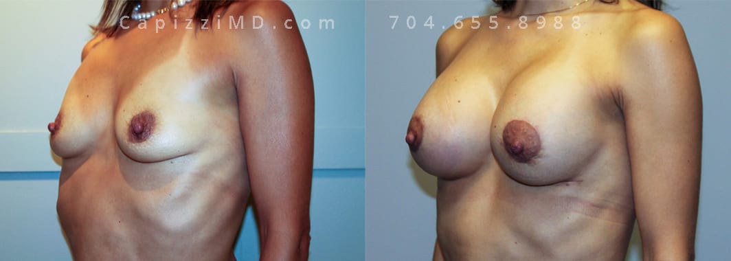 5’ 107lbs. Breast augmentation with modified lift. Sientra Textured Shaped Round Base HP 370cc. 6 months post. Left oblique view.