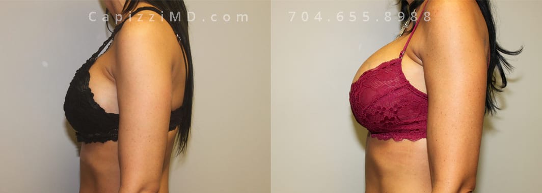 Wearing bra. Original implants: Mentor MemoryGel 600 cc. New implants: Memory MemoryGel Xtra 765cc HP. 4 weeks post op. Left view.
