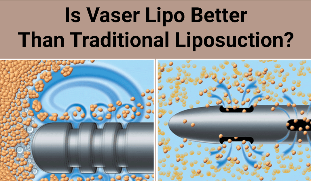 Vaser Lipo breaking up fat cells with ultrasound and traditional Liposuction tip sucking up fat cells.