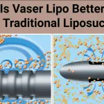 Vaser Lipo breaking up fat cells with ultrasound and traditional Liposuction tip sucking up fat cells.