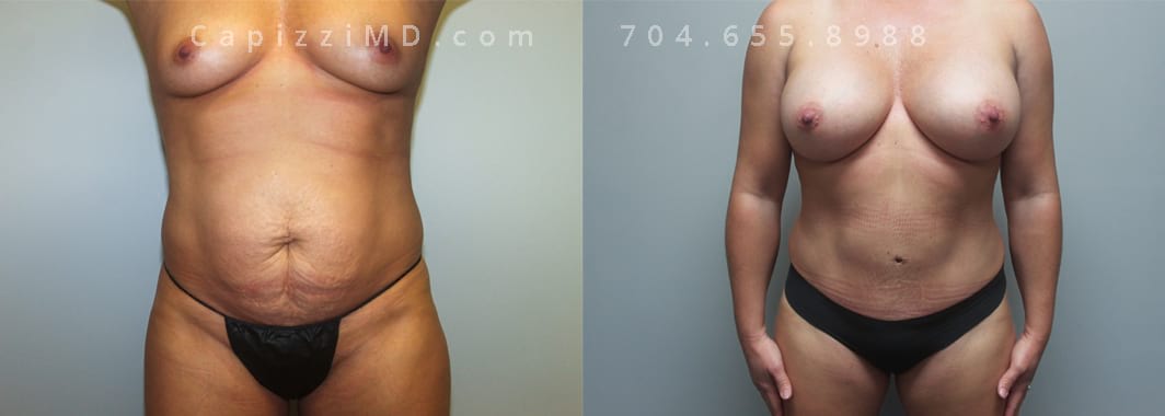 Sientra Smooth Round HP 440cc. 5’ 3” 152lbs, Standard Tummy Tuck. Liposuction to Posterior Hips and Abdomen. Full front view.