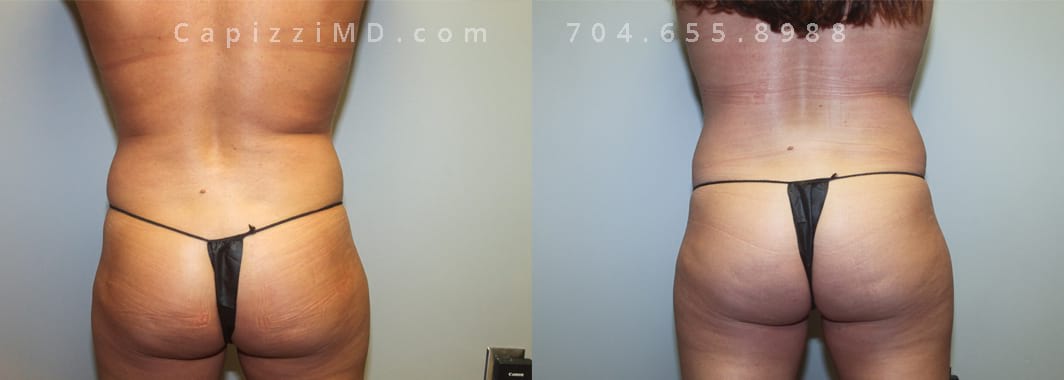 Sientra Smooth Round HP 440cc. 5’ 3” 152lbs, Standard Tummy Tuck. Liposuction to Posterior Hips and Abdomen. Lower back view.