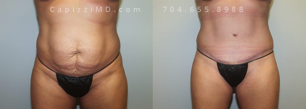 Sientra Smooth Round HP 440cc. 5’ 3” 152lbs, Standard Tummy Tuck. Liposuction to Posterior Hips and Abdomen. Lower front view.