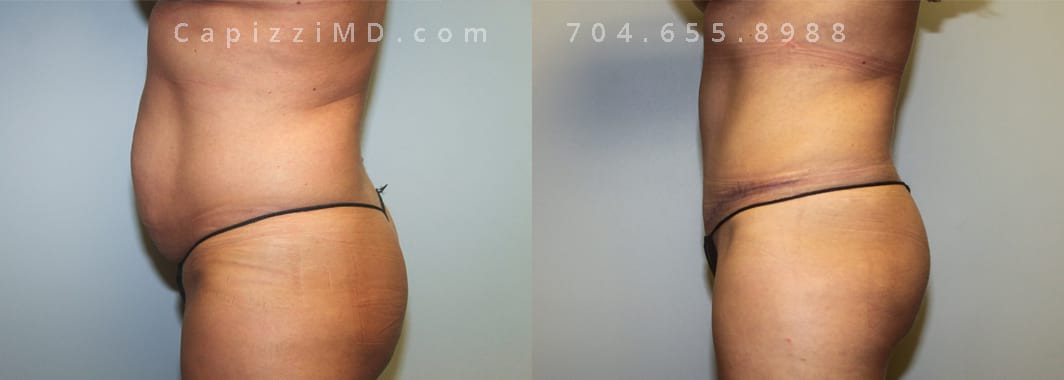 Sientra Smooth Round HP 440cc. 5’ 3” 152lbs, Standard Tummy Tuck. Liposuction to Posterior Hips and Abdomen. Lower left view.