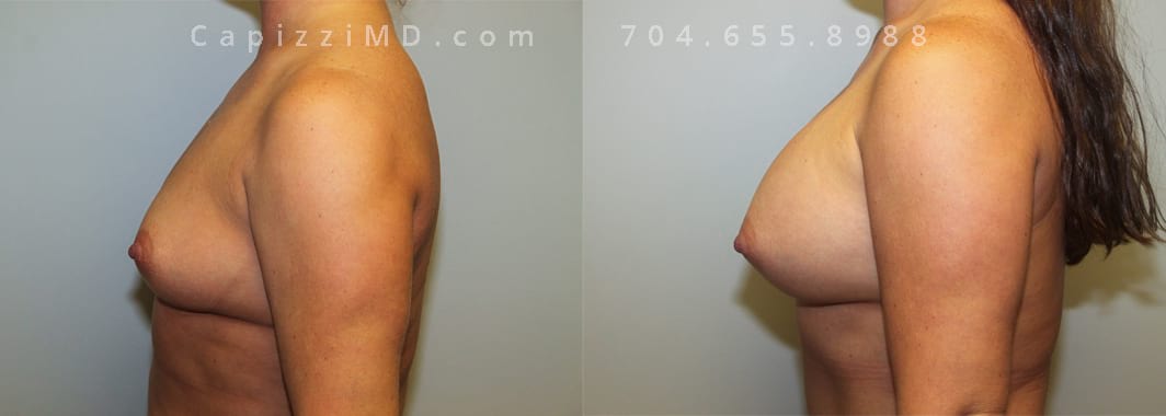 Sientra Smooth Round HP 440cc. 5’ 3” 152lbs, Standard Tummy Tuck. Liposuction to Posterior Hips and Abdomen. Left view.