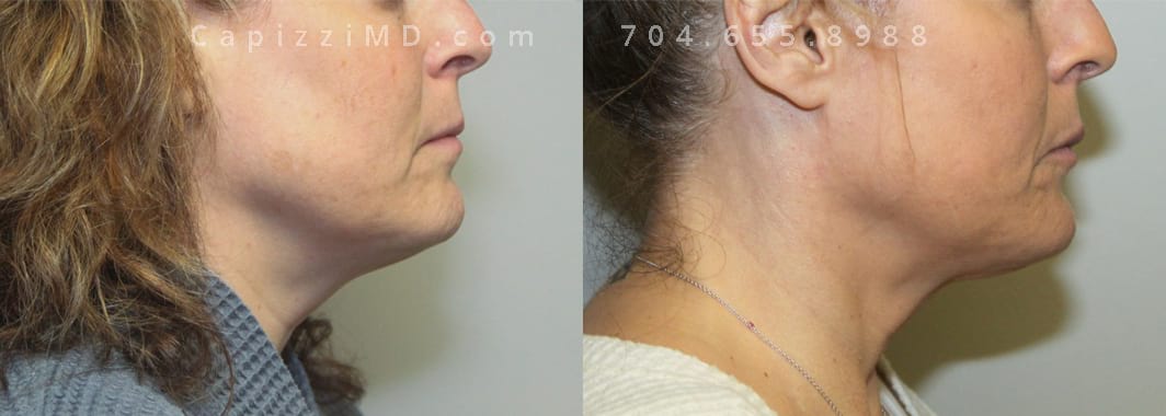 Post-procedure pics taken 4 months post-tx. Profound and 1 treatment of Kybella. Right view.