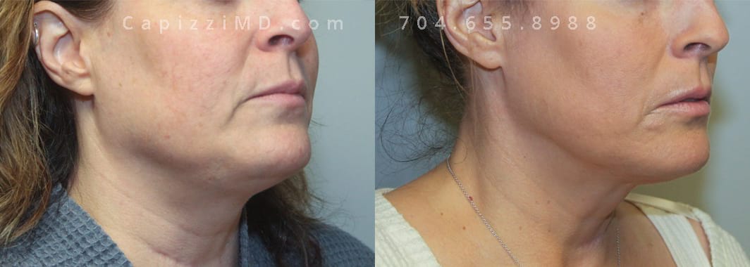 Post-procedure pics taken 4 months post-tx. Profound and 1 treatment of Kybella. Right oblique view.