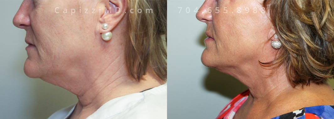Profound + One Tx of Kybella. 4 months post. Left view.