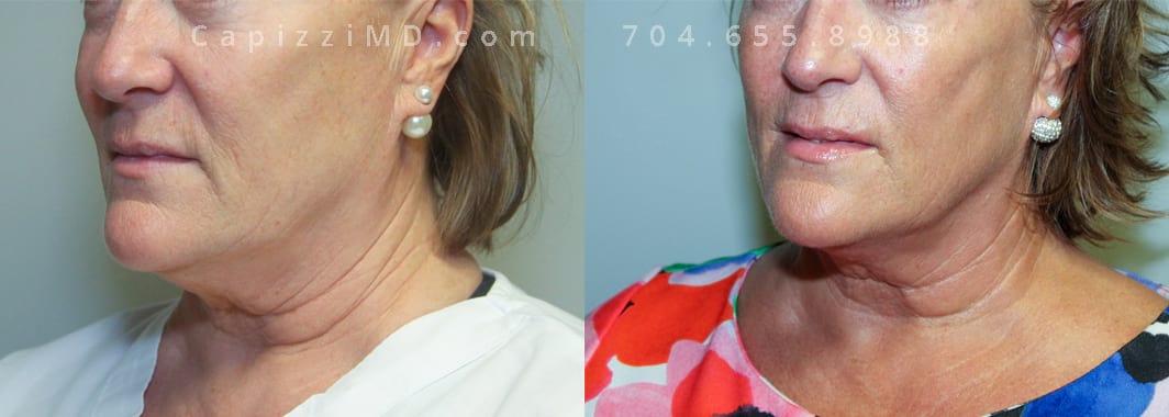Profound + One Tx of Kybella. 4 months post. Left oblique view.