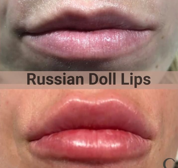Russian Doll Lip Filler before and after pictures.