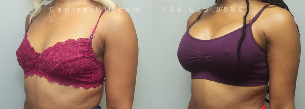 Sientra Smooth Round HP 440cc. 5’3” 133lbs. 3 months post-op. Left oblique view with bra.