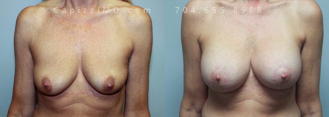 Breast Augmentation + Mini Lift Height 5’ 8” Weight 130lbs. Sientra Smooth Rd HP 385cc (R) 415cc (L). Front view.