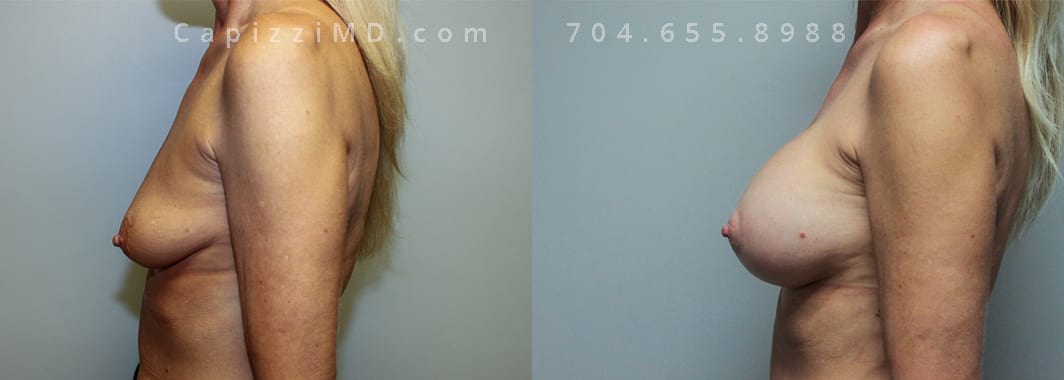 Breast Augmentation + Mini Lift Height 5’ 8” Weight 130lbs. Sientra Smooth Rd HP 385cc (R) 415cc (L). Left view.