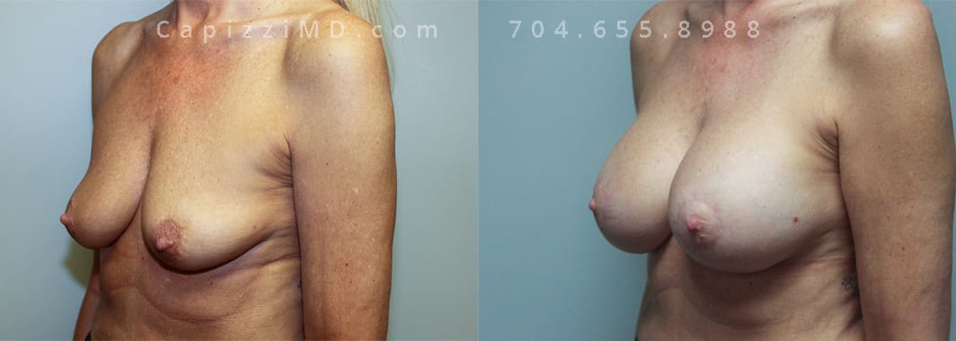 Breast Augmentation + Mini Lift Height 5’ 8” Weight 130lbs. Sientra Smooth Rd HP 385cc (R) 415cc (L). Left oblique view.