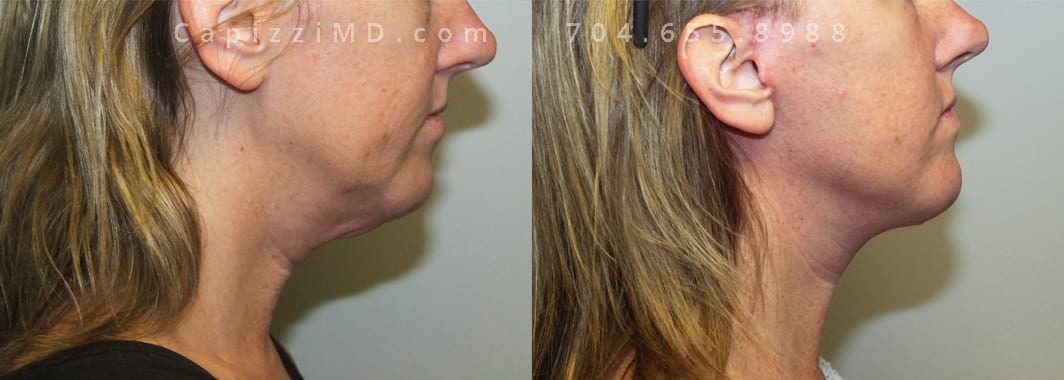 Lower facelift, 6 months post, Age 43. Right view