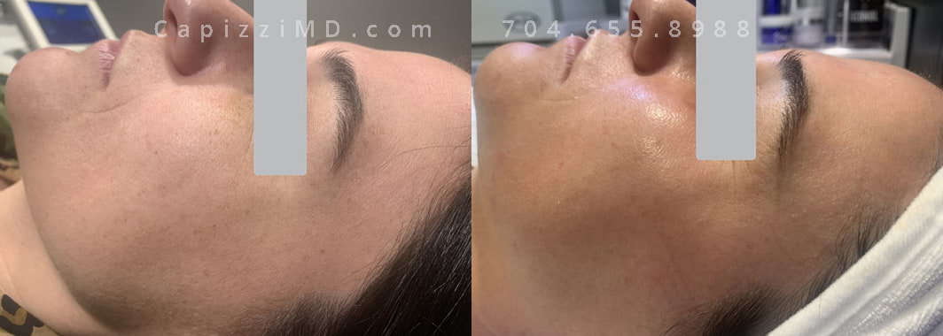 BBL series of 3 treatments, photographed 4 weeks after the 3rd treatment. Left side view.
