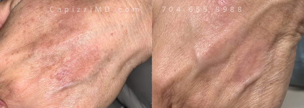 BBL series of 3 treatments, photographed 4 weeks after the 3rd treatment. Left hand.