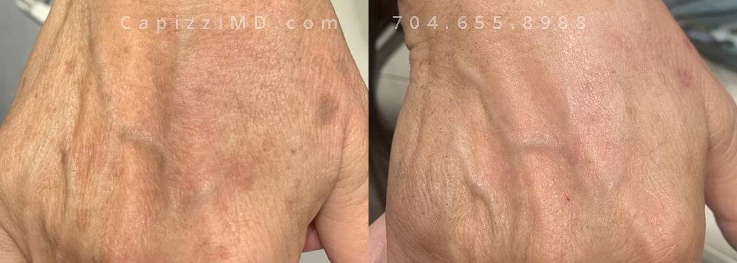 BBL series of 3 treatments, photographed 4 weeks after the 3rd treatment. Right hand.