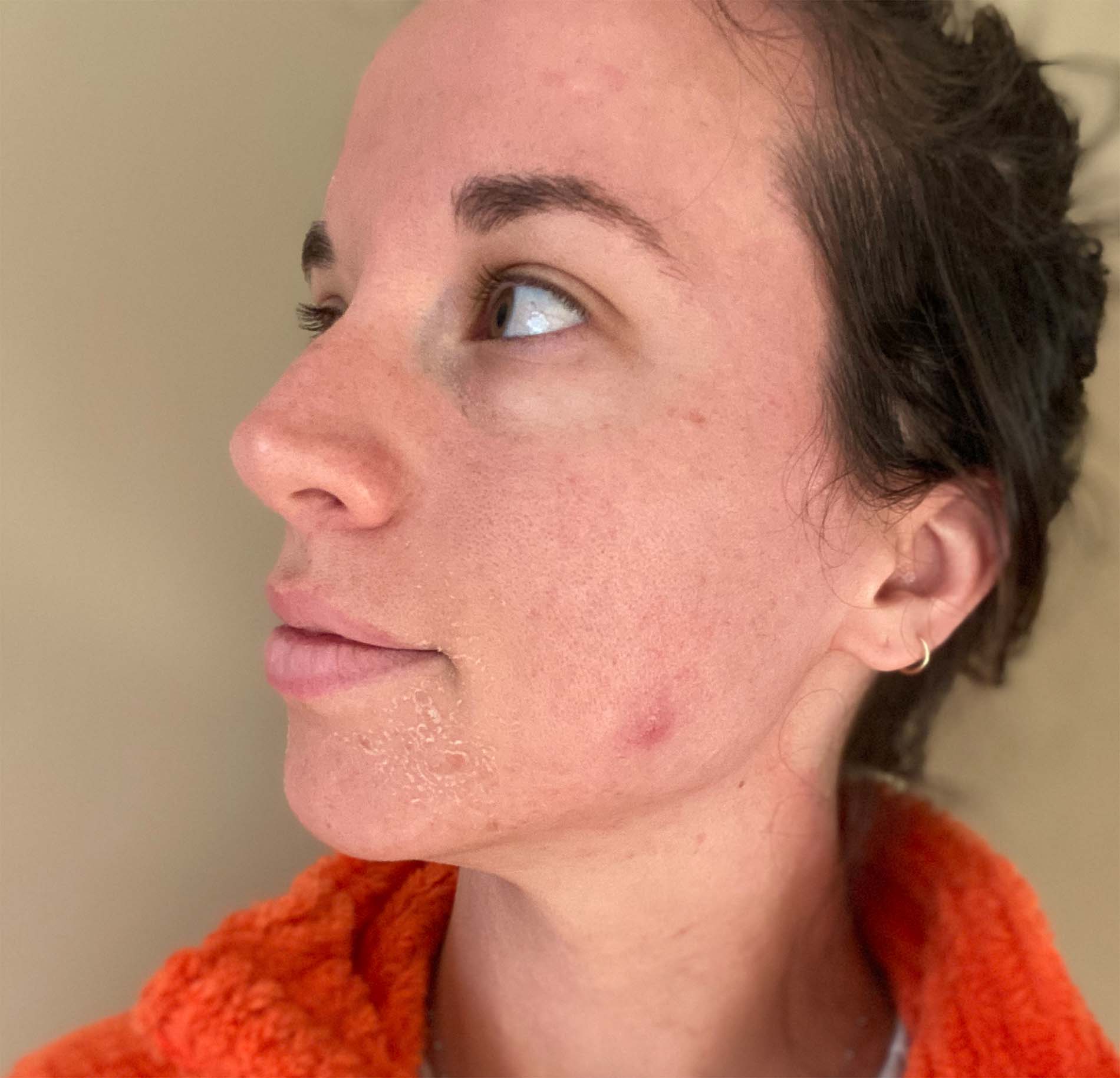 2 Days After Medium-level Chemical Peel showing some mild peeling on the left chin area.