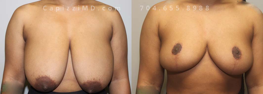 Breast Reduction with liposuction to bra roll. Front view.