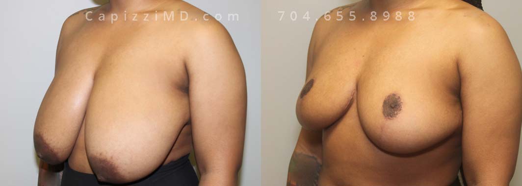 Breast Reduction with liposuction to bra roll. Left oblique view.