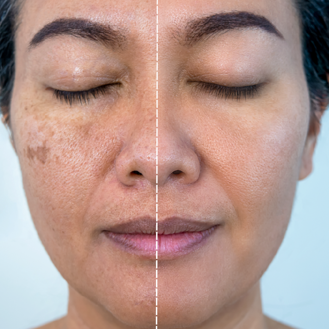 Cosmelan peels penetrate the skin to remove melasma and hyperpigmentation in just one treatment