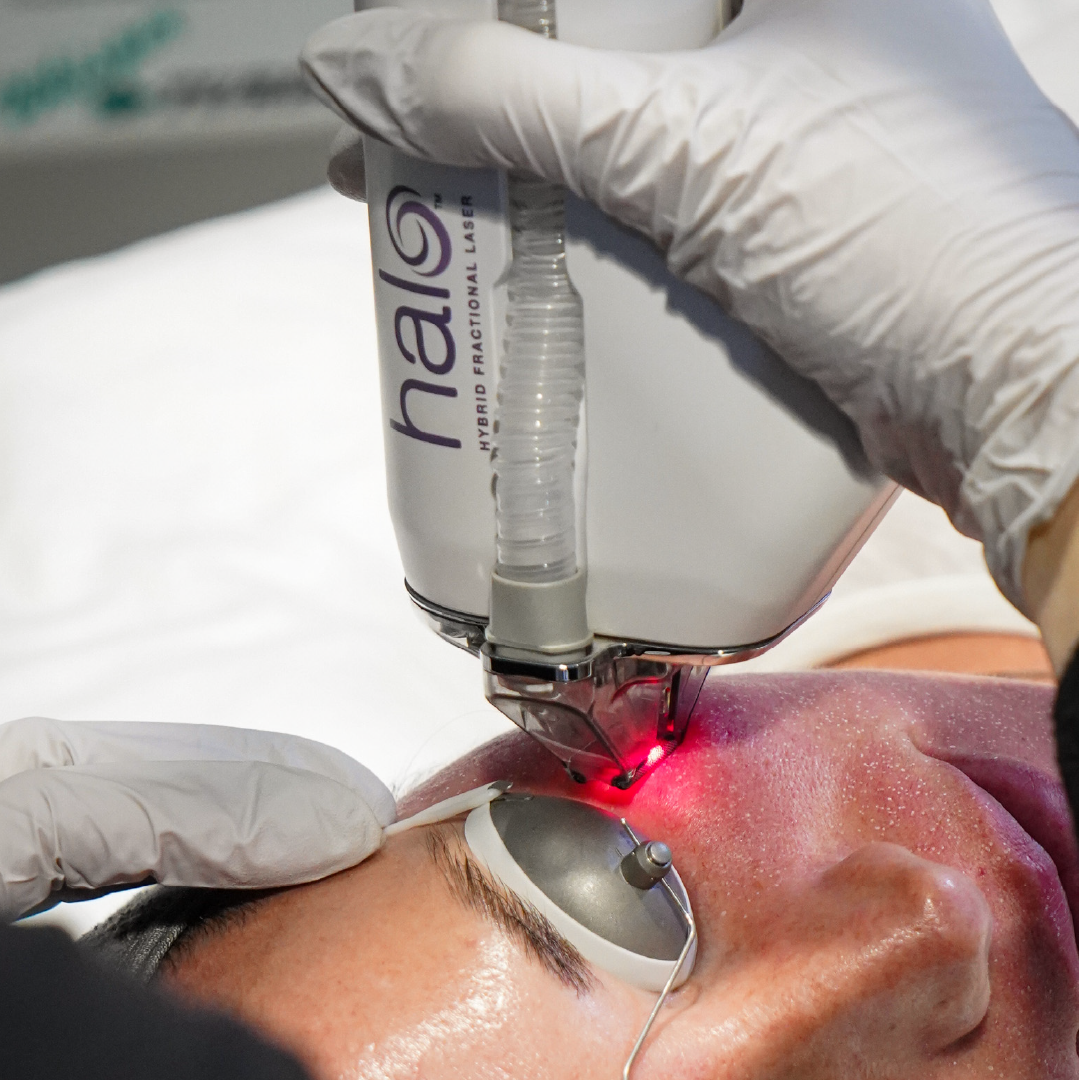 HALO laser treatment resurfaces and smooths skin while removing unwanted pigmentation