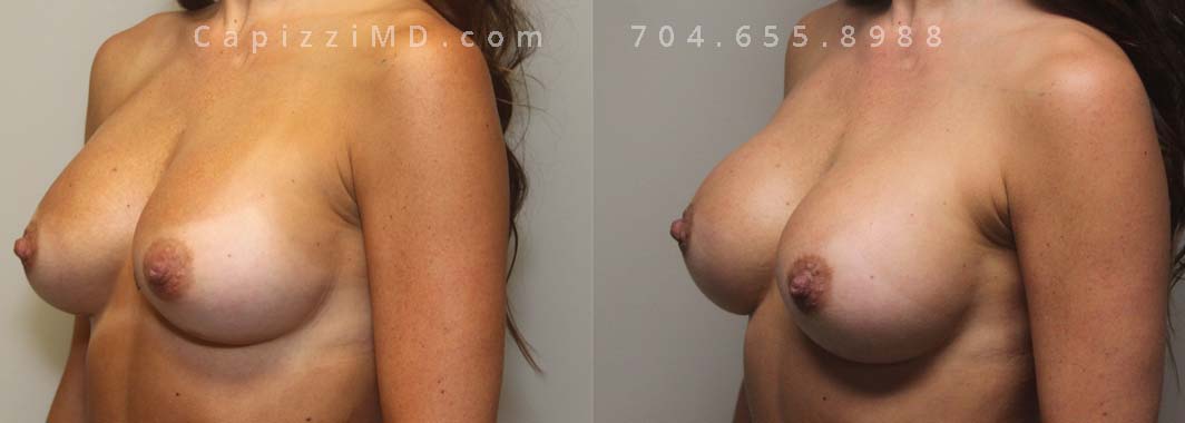 Breast implant exchange from Sientra 285cc MP to Sientra 385cc HP. Left oblique view.