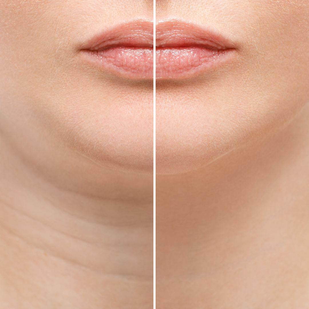 Kybella injectable dissolves submental fat and erases your double chin