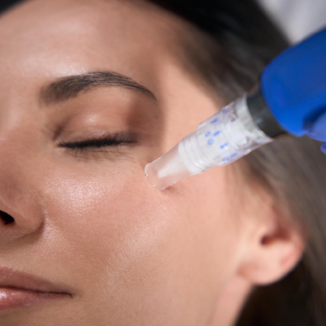 Microneedling smooths skin texture and erases acne scarring