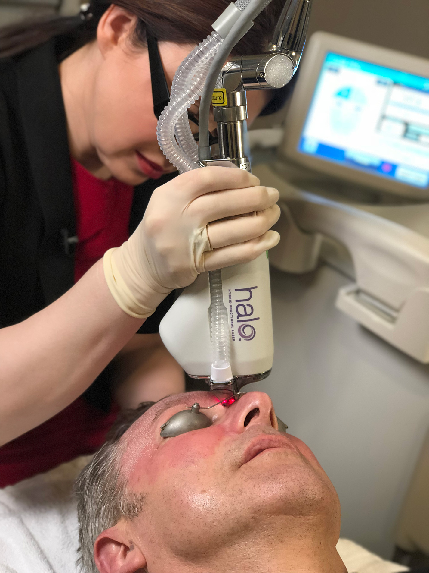 HALO Laser being used between a man's eyes to reduce aging and wrinkles at Capizzi MD.