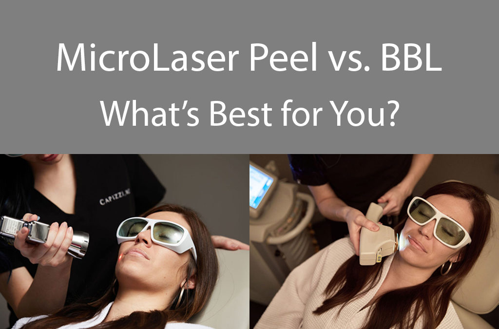 Images of women getting MicroLaser Peel and Broad Band Laser Treatments with the words :MicroLaser Peel vs. BBL What is best for you?