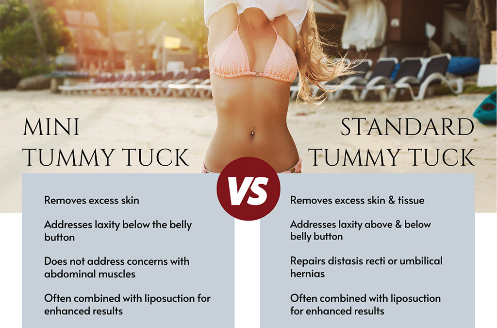 Mini Tummy Tuck comparison with Standard Tummy Tuck.