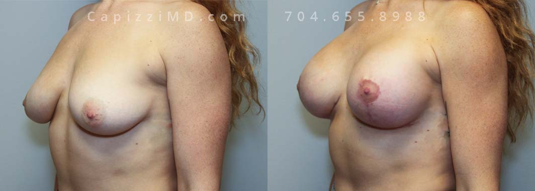 Breast Augmentation + Lift 15 Left Oblique view.