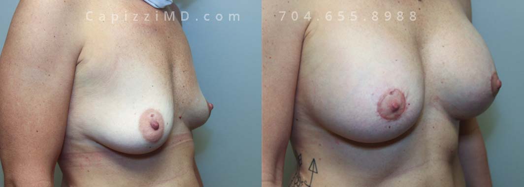 Breast Augmentation + Lift 17 Right Oblique view.