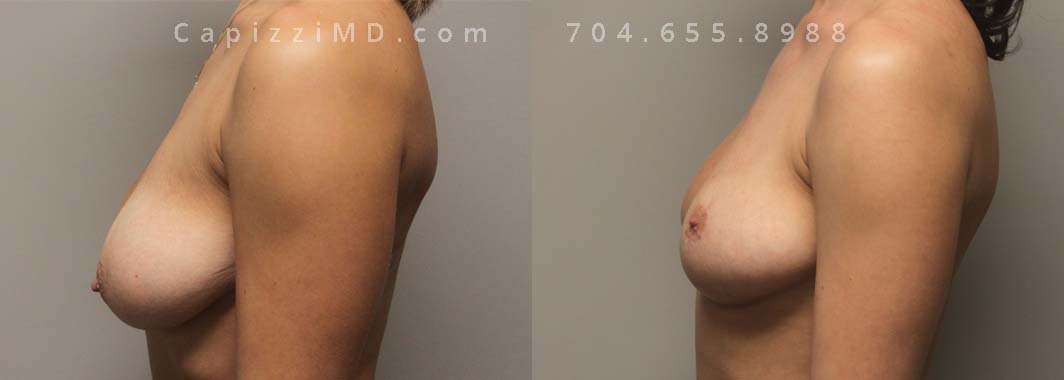 Breast Reduction 8 Left view.