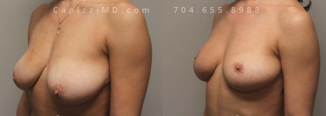 Breast Reduction 8 Left Oblique view.