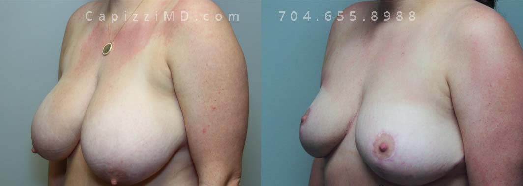 Breast Reduction 9 Left Oblique view.
