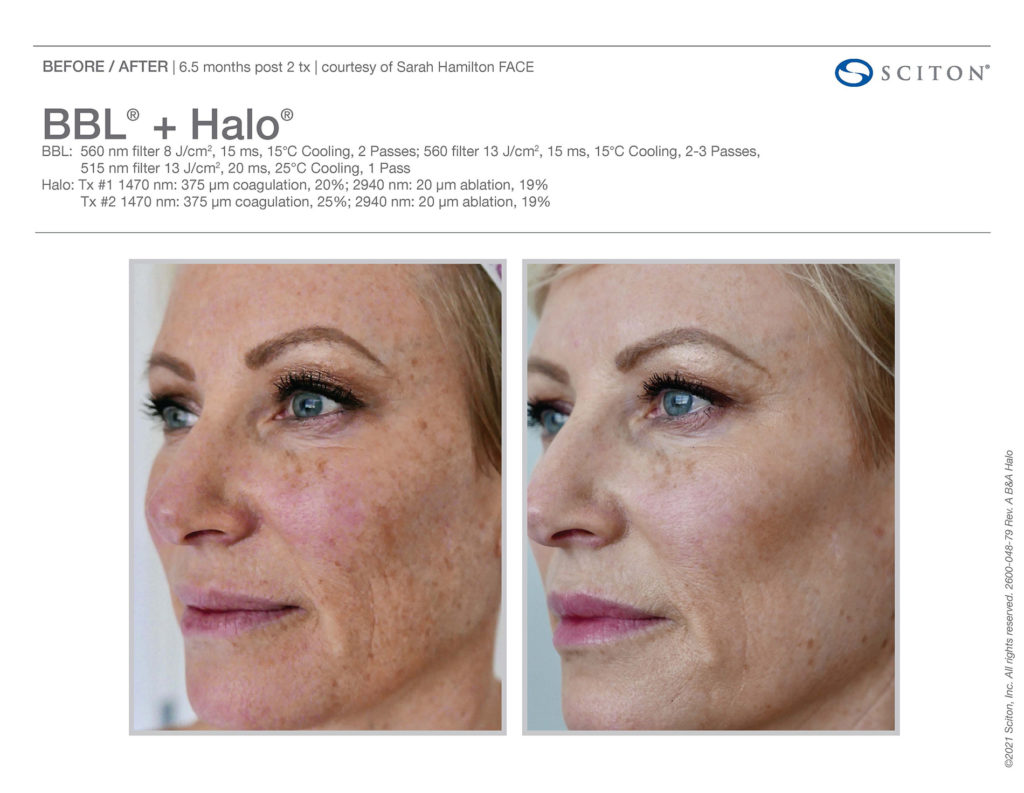 HALO treatment before and after showing the reduction in redness on the face.