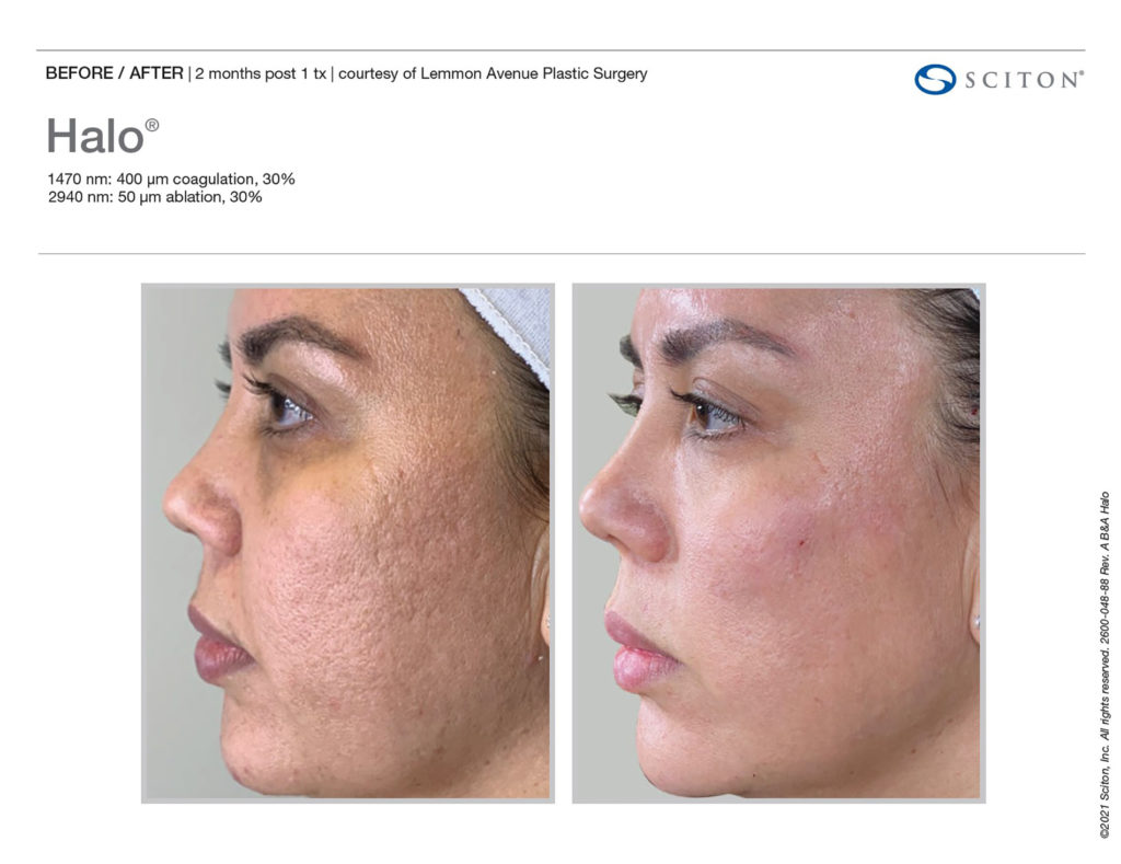 HALO treatment before and after showing the increase in skin smoothness of the face.