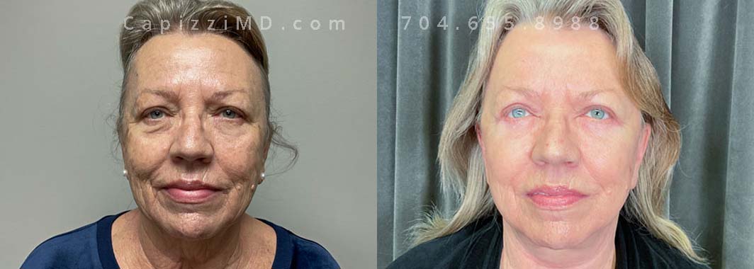 Upper & Lower eyelid lifts, Lower Facelift, Neck Lift, MLP/BBL laser treatments. Front view.