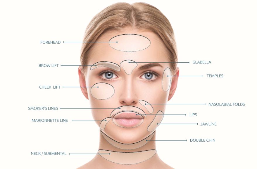 Woman's face marked for areas that can be helped using PDO Thread Lifts.